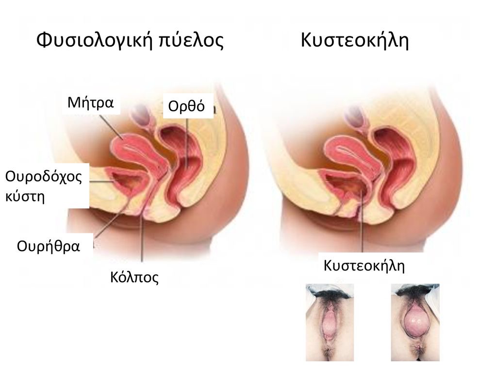 Κυστεοκήλη
