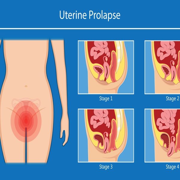 Pelvic,Floor,Prolapse,Type,Uterine,Uterus,Biofeedback,Pelvic,Floor,Treatment προπτωση μητρας