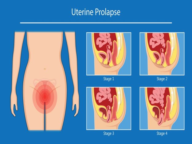 Pelvic,Floor,Prolapse,Type,Uterine,Uterus,Biofeedback,Pelvic,Floor,Treatment προπτωση μητρας