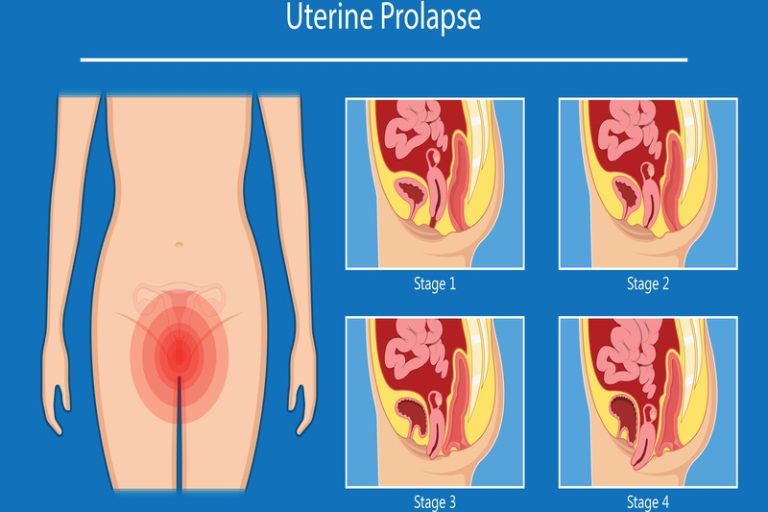 Pelvic,Floor,Prolapse,Type,Uterine,Uterus,Biofeedback,Pelvic,Floor,Treatment προπτωση μητρας