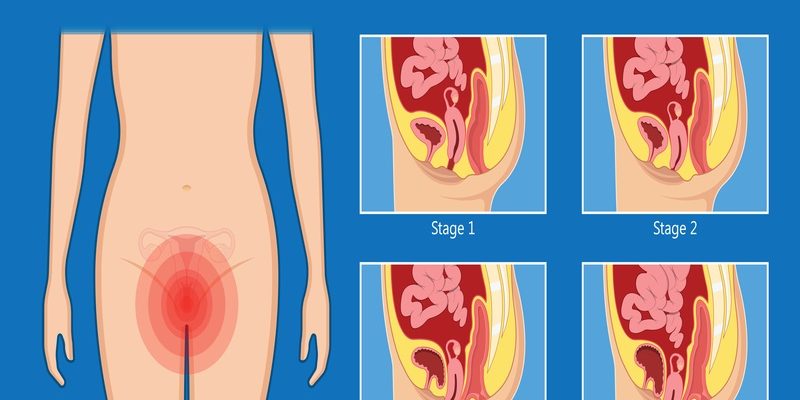 Pelvic,Floor,Prolapse,Type,Uterine,Uterus,Biofeedback,Pelvic,Floor,Treatment προπτωση μητρας